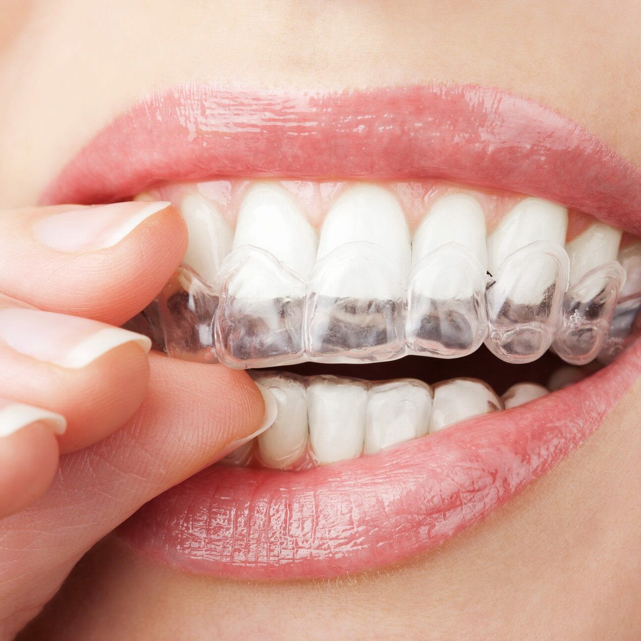 https://www.butterflydental.net/wp-content/uploads/bb-plugin/cache/ClearAligners-square.jpg